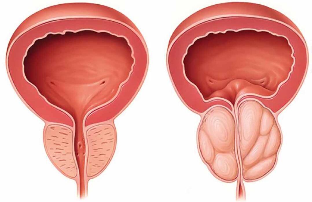 Normal prostate and prostatitis (chronic prostatitis)