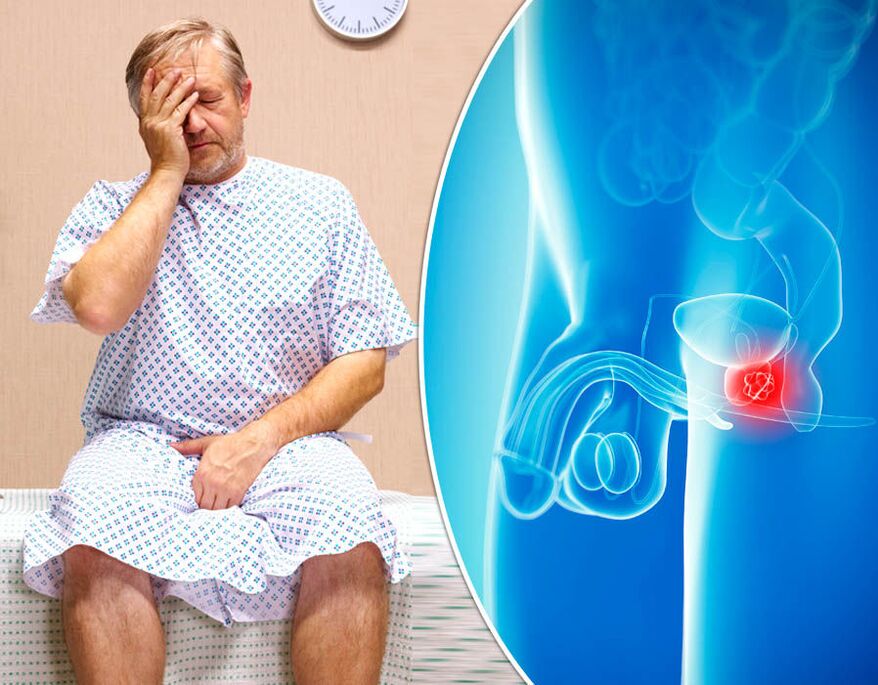A man with prostatitis is diagnosed with the disease