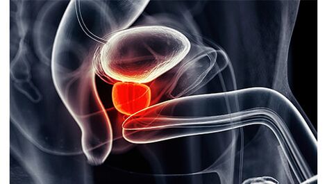 inflammation of the prostate gland